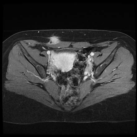 scar endometriosis radiology